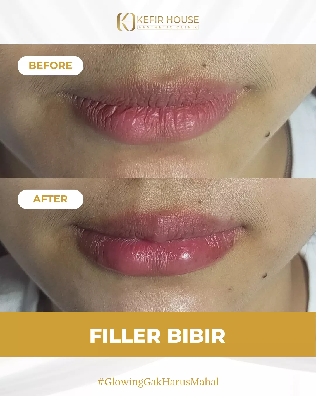 Filler Before After