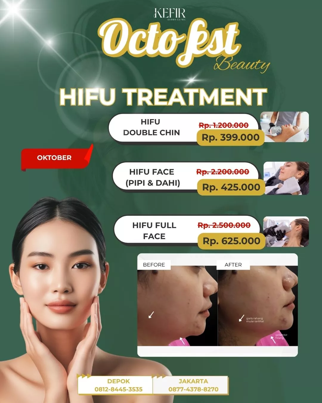 Hifu Treatment KDC Oktober 2025