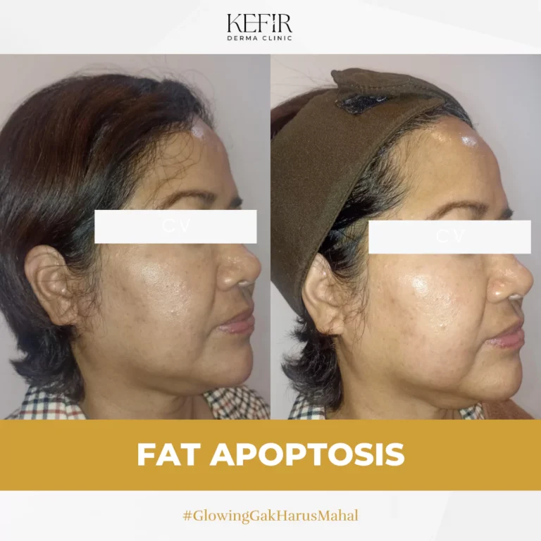 Before After Fat Apoptosis