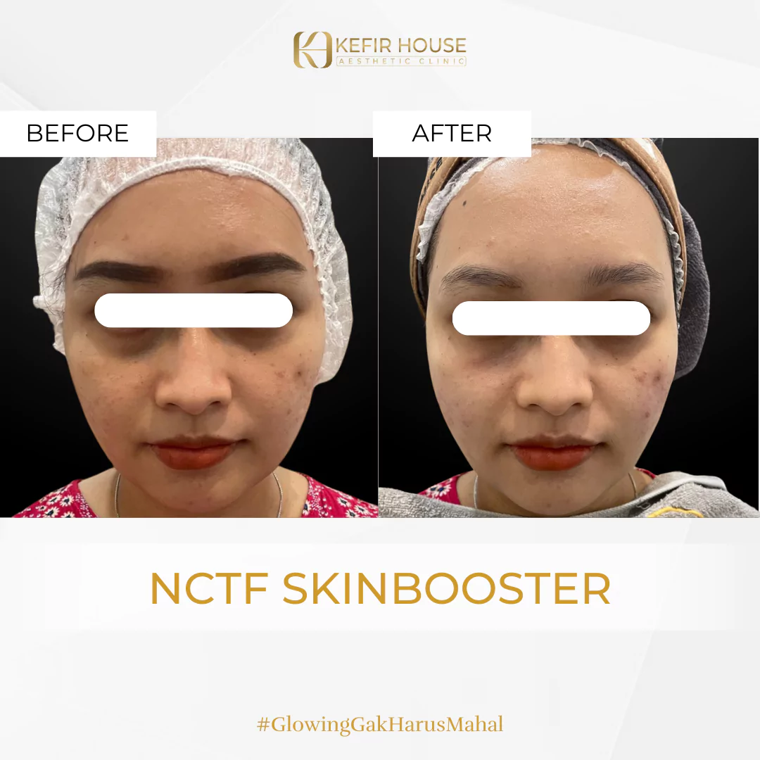 NCTF Skin Booster 2