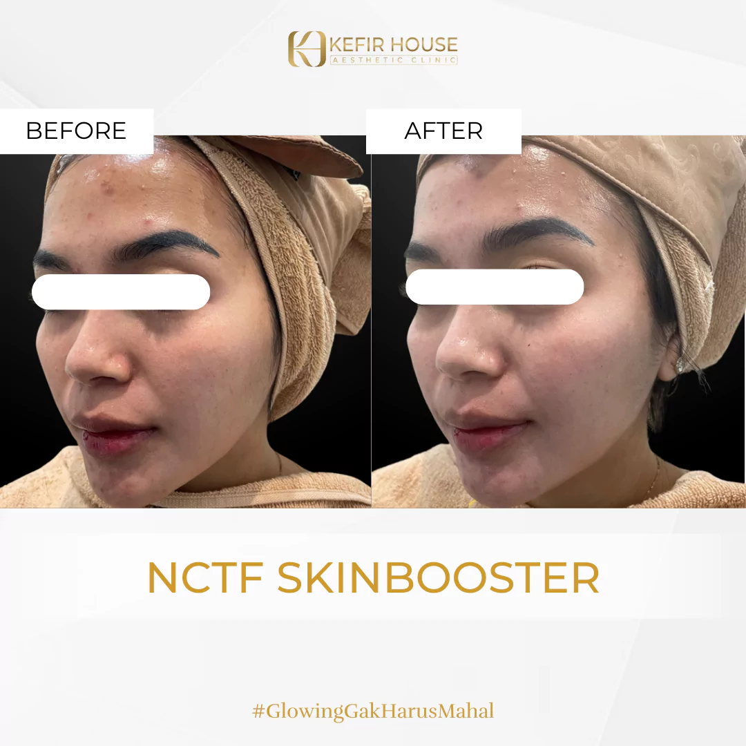 NCTF Skin Booster 1